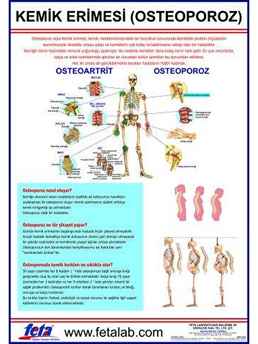 Edulab Osteoporoz Eğitim Plakası (Kemik Erimesi)